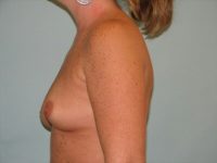 Breast Augmentation