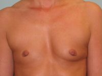 Breast Augmentation