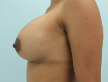 Breast Augmentation