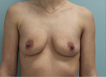 Breast Augmentation