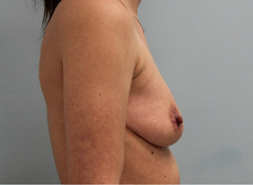 Breast Augmentation