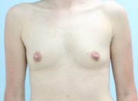 Breast Augmentation