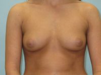 Breast Augmentation