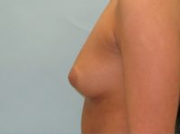 Breast Augmentation