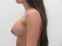 Breast Augmentation