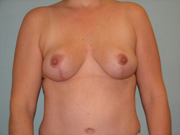 breast reconstruction after