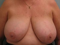 Breast Reduction