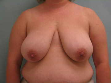 Breast Reduction