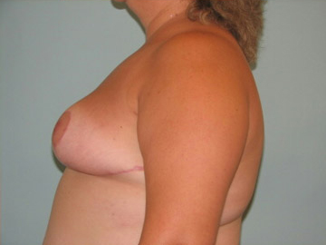 Breast Reduction