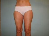 Liposuction