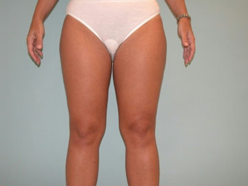 Liposuction