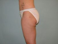 Liposuction