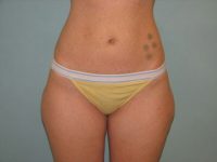 Liposuction