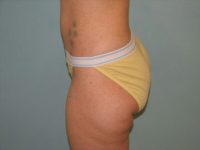 Liposuction