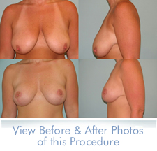 breast lift before and after photos