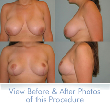 breast reduction - before and after photos