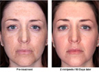 Chemical Peels - before and after result