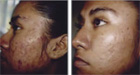 Chemical Peels - before and after