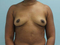 Breast Augmentation