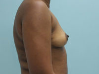 Breast Augmentation