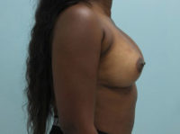 Breast Augmentation