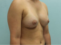 Breast Augmentation