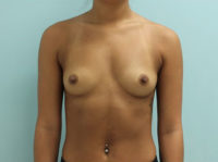 Breast Augmentation