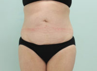 Abdominoplasty