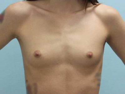 Breast Augmentation