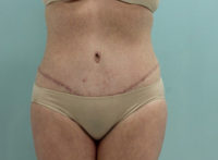 Abdominoplasty