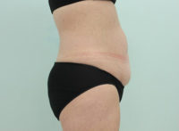 Abdominoplasty