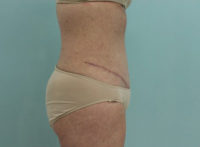 Abdominoplasty