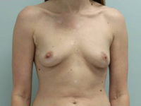 Breast Augmentation