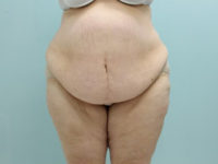 Abdominoplasty