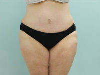 Abdominoplasty