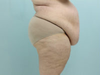 Abdominoplasty