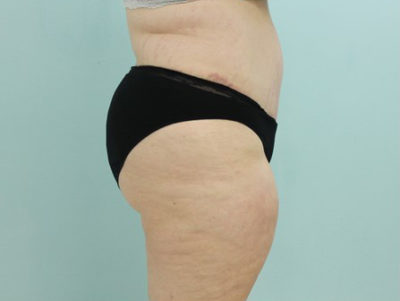 Abdominoplasty