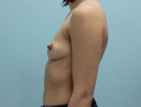 Breast Augmentation