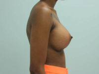 Breast Augmentation