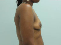 Breast Augmentation