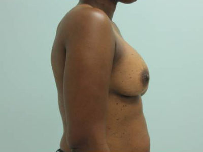 Breast Augmentation