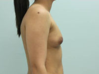 Breast Augmentation