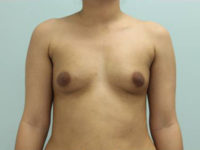 Breast Augmentation