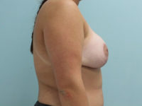 Augmentation & Mastopexy