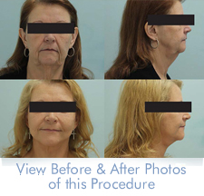 facelift - view before and after photos