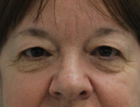 Blepharoplasty