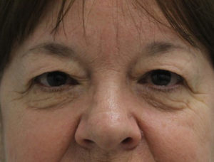 Before Eyelid life procedure