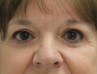 Blepharoplasty