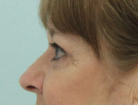 Blepharoplasty