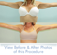 Arm Lift Surgery Results Athens